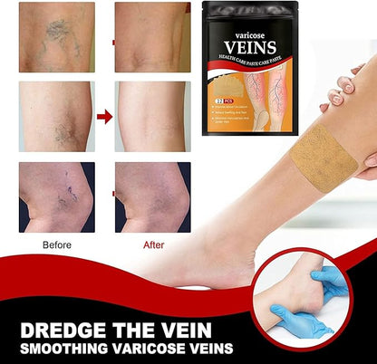 Heat patches for varicose veins treatment, 12 pcs, designed to help reduce spider veins and leg discomfort.